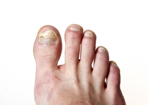 Definition and Risk Factors for Toenail Fungus