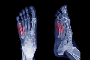 Symptoms of a Jones Fracture
