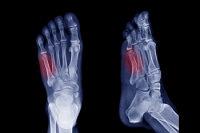 Symptoms of a Jones Fracture