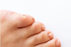 How to Identify and Treat a Foot Corn