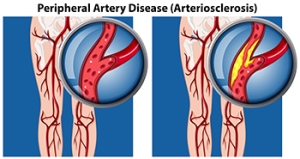 How Poor Circulation Affects Your Feet