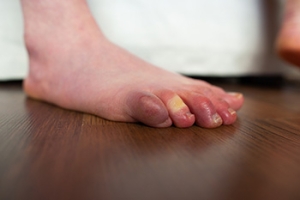 Raynaud&#039;s Phenomenon and Its Impact on the Feet