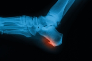 Types of Surgery for Foot Bone Spurs