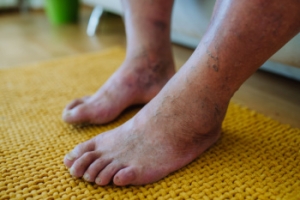 Why Limb Salvage in Diabetes Can Be Life Saving