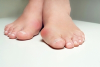 What Can Cause Bunions?