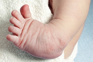 Treatment Options for Clubfoot
