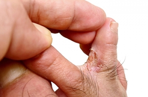 Types of Athlete&#039;s Foot